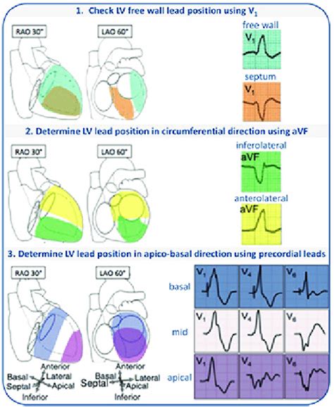 lv pacing lead placement